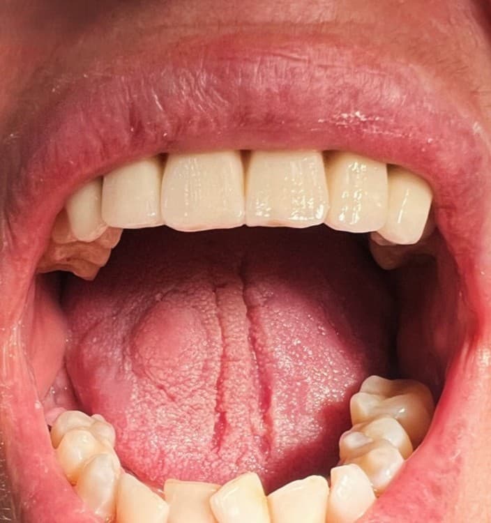 Restauration esthétique — Après