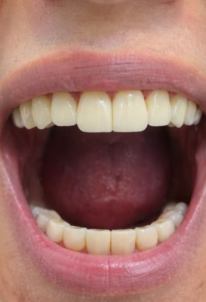 Remplacement et couronne — Après