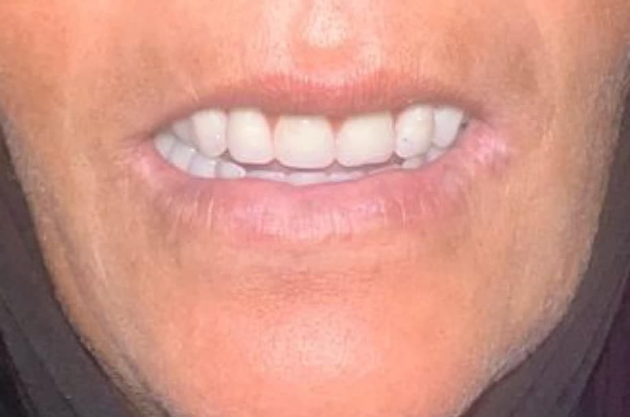 Réhabilitation complète — Après