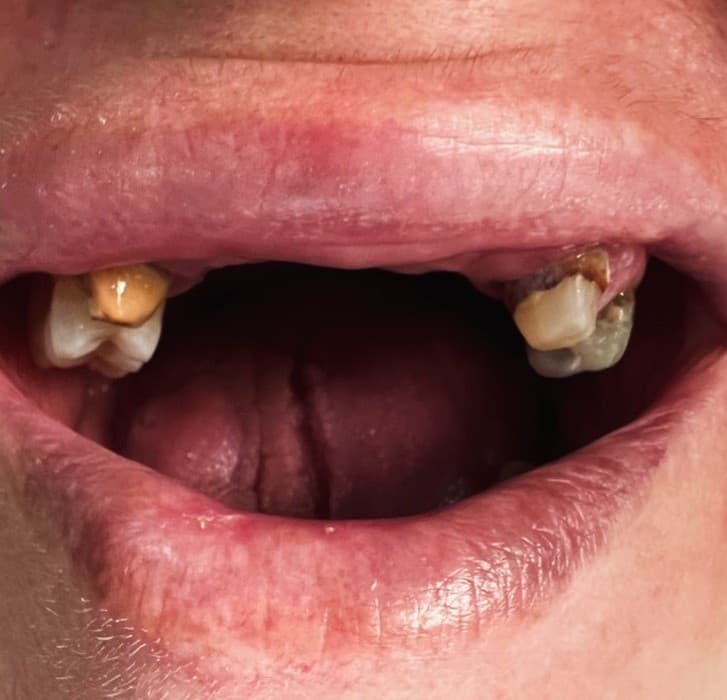 Restauration esthétique — Avant