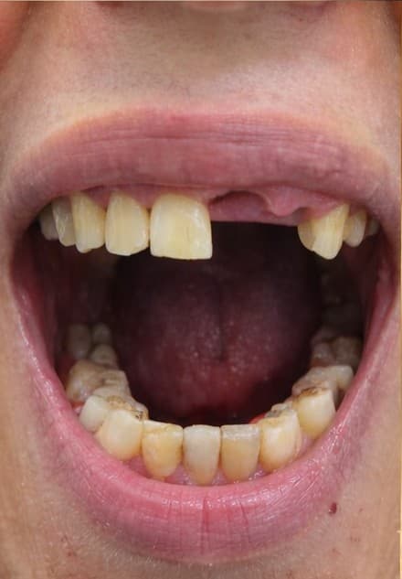 Remplacement et couronne — Avant