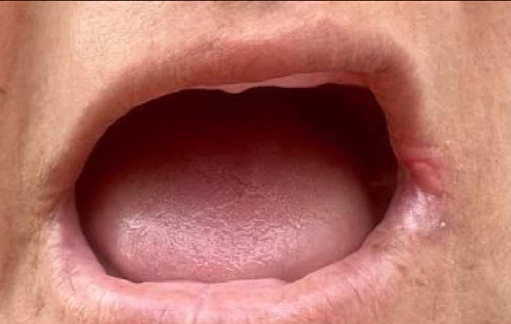 Réhabilitation complète — Avant